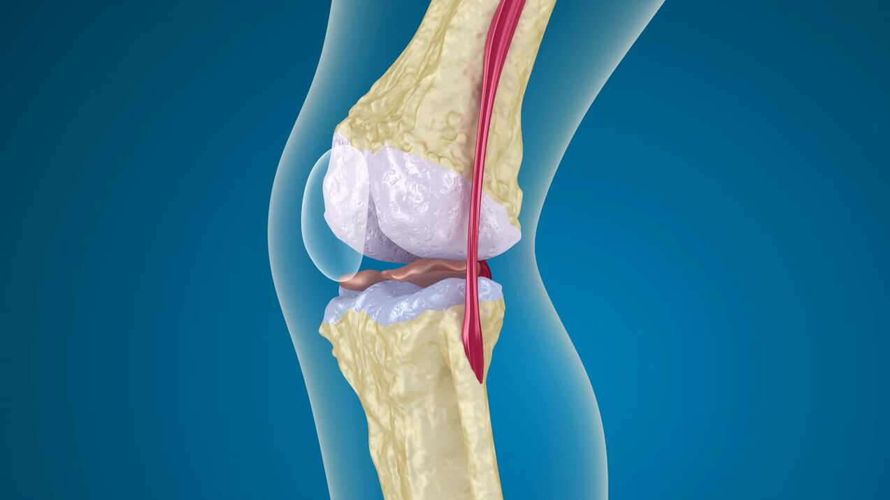 Knee joint destruction and arthropathy