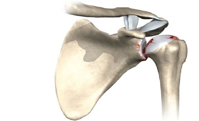 Shoulder Injuries Caused by Arthropathy