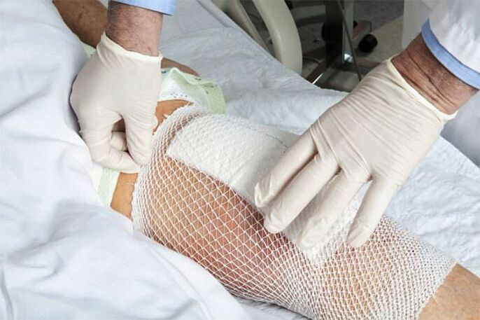 Therapeutic compression for knee arthropathy