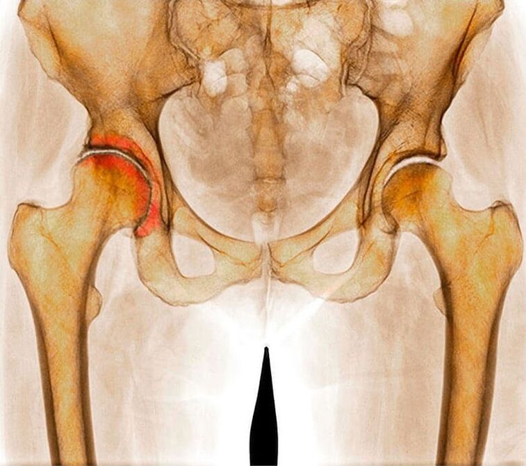 Hip Inflammation Causes Pain