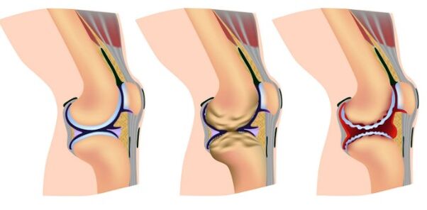 Knee deformation stage
