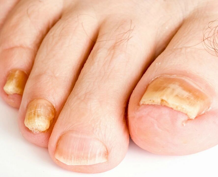 Fungus on nails