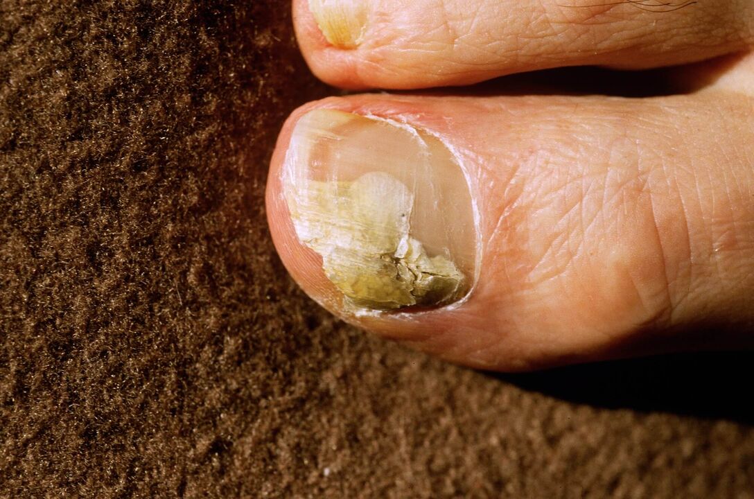 Streptomycesiasis