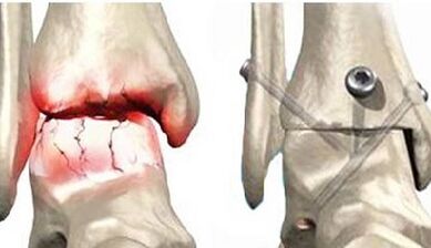 Surgery treatment of knee joints