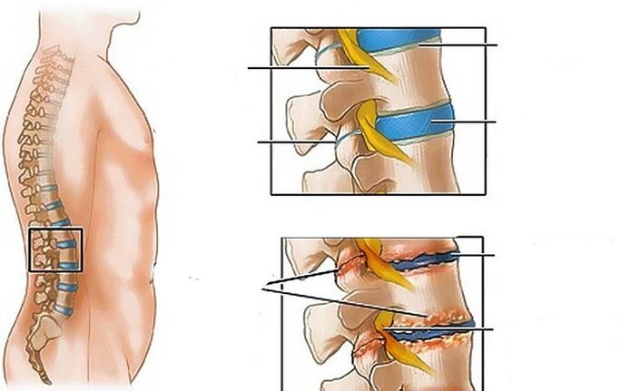 Osteochondral disease in the waist