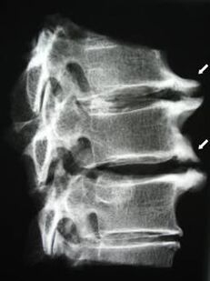 Cervical osteophytes causing neck pain