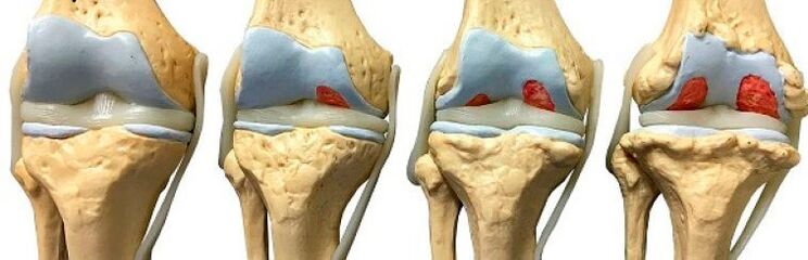 Various stages of knee joint disease