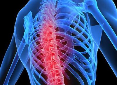 Thoracic osteochondrosis