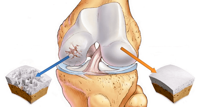 Healthy Cartilage and Cartilage Affected by Arthropathy