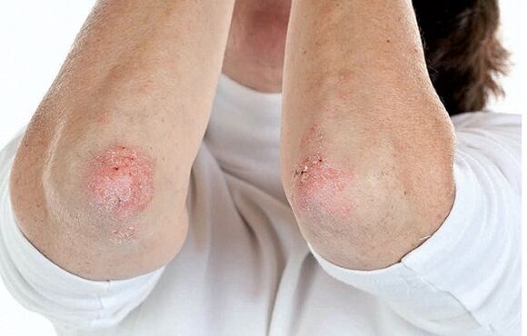 People with psoriasis are more likely to develop psoriatic arthritis