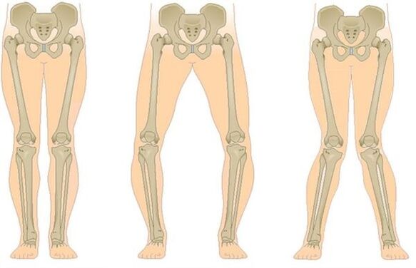 Types of Arthropathy