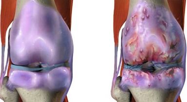 The main differences between arthritis and arthritis