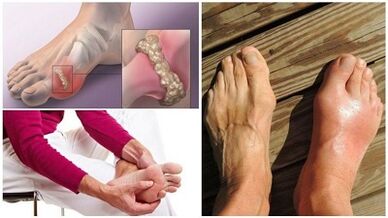 What is arthritis