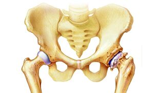 Why does hip joint arthritis occur