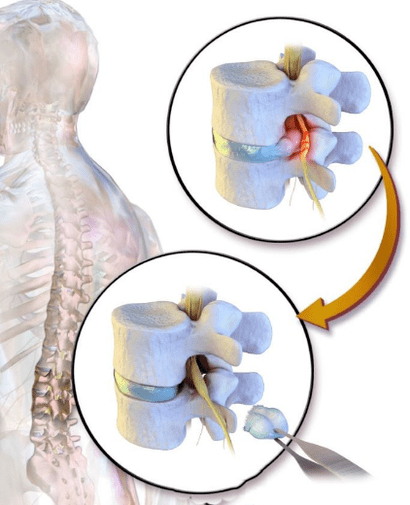 Discectomy for low back pain